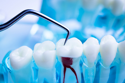 A 3d rendering of a tooth its roots highlighted